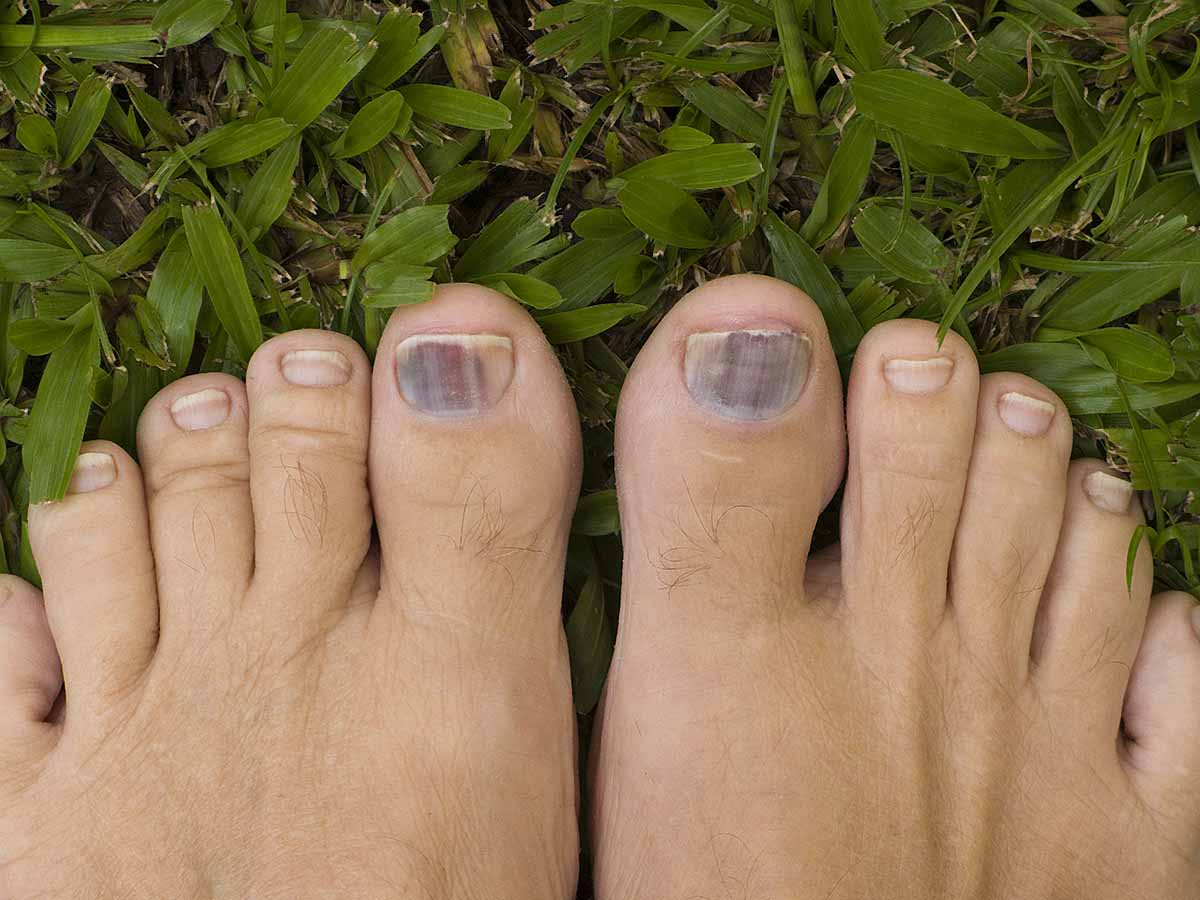 Hammer Toe